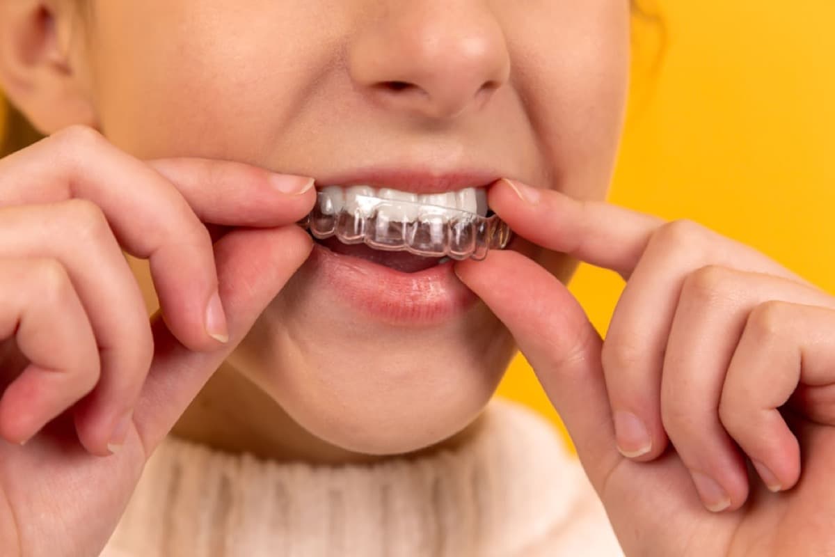 Paciente colocándose un alineador dental transparente